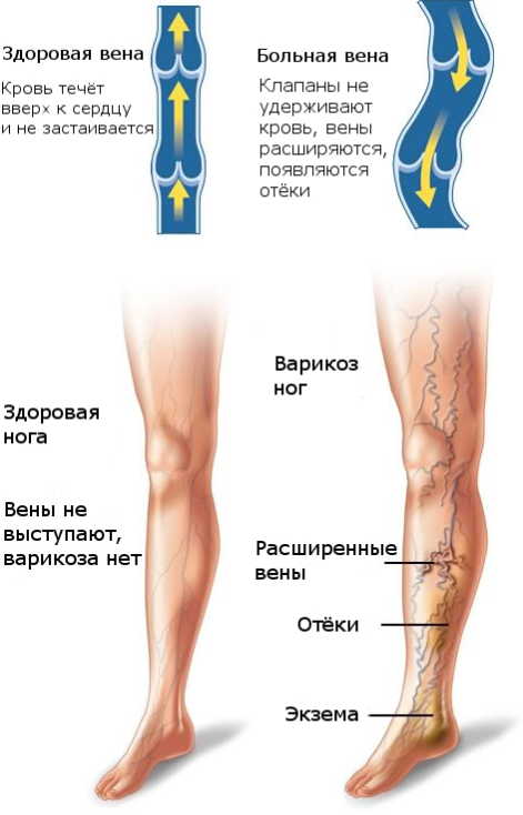 Варикоз Без Операции Boot