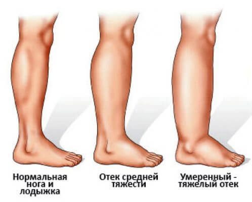Полезные упражнения при застое лимфы в ногах