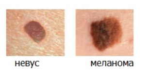 Меланома — самая опасная разновидность рака кожи. Можно ли удалять родинки? И как понять, что родинка безопасна?