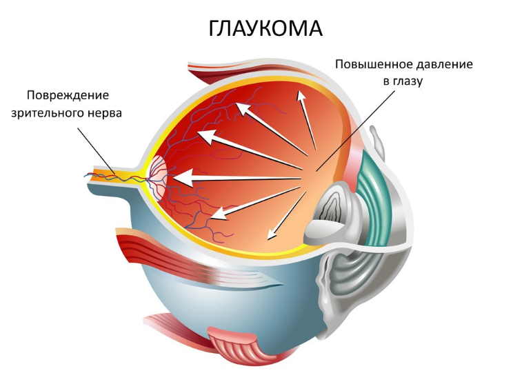 Глаукома — народные рецепты лечения коварного недуга. Будут глаза здоровы!