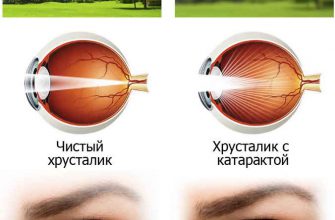 От катаракты простое лечение, в обычной травке — глаз спасение