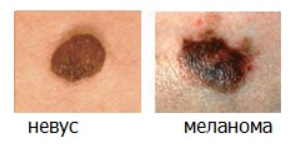 Меланома — самая опасная разновидность рака кожи. Можно ли удалять родинки? И как понять, что родинка безопасна?