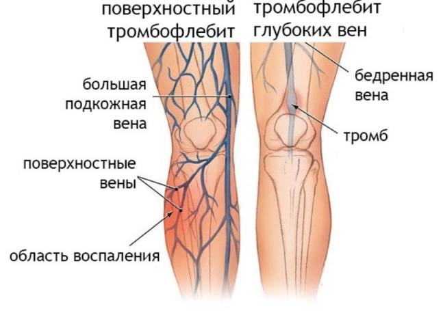 Как соседка тяжелый тромбофлебит вылечила. Опыт, которым нужно делиться. Будьте все здоровы!