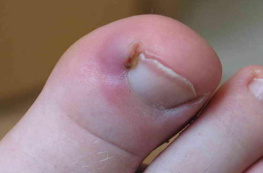 Домашнее лечение вросшего ногтя — народными методами можно быстро справиться с проблемой
