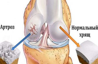 Лечебная гимнастика при артрозе