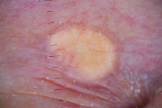 Появление ксантом на коже: безобидный симптом или серьезная угроза для организма