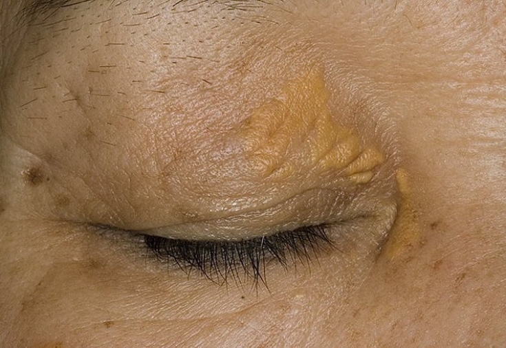 Появление ксантом на коже: безобидный симптом или серьезная угроза для организма