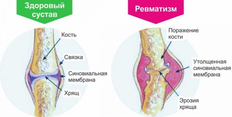 Ревматизм коленного сустава у детей. Ревмокардит - причины, симптомы, диагностика и лечение Рекурвация коленного сустава у ребенка: что это такое, факторы развития. Вальгусная деформация коленных суставов: фото, причины, лечение