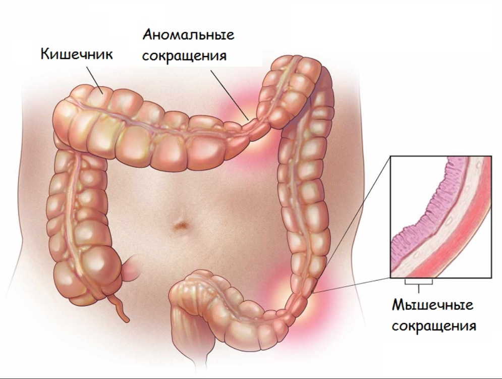 Врач-гастроэнтеролог: синдром раздраженного кишечника — что это такое?