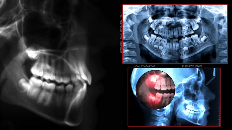 Что лучше — штифт или имплант? Все подводные камни имплантации зубов! Есть адские минусы… Как всё происходит и стоит ли соглашаться?