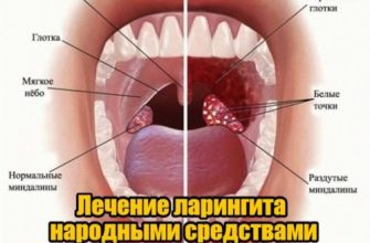 Лечим ларингит народными средствами
