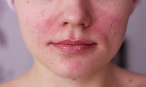 Виды и симптомы аллергии