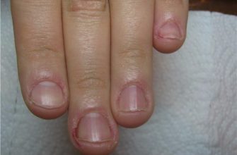 Как перестать грызть ногти?