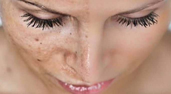 8 рецептов быстрого устранения пигментных пятен на коже
