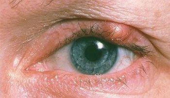 Народные методы лечения ячменя глаза