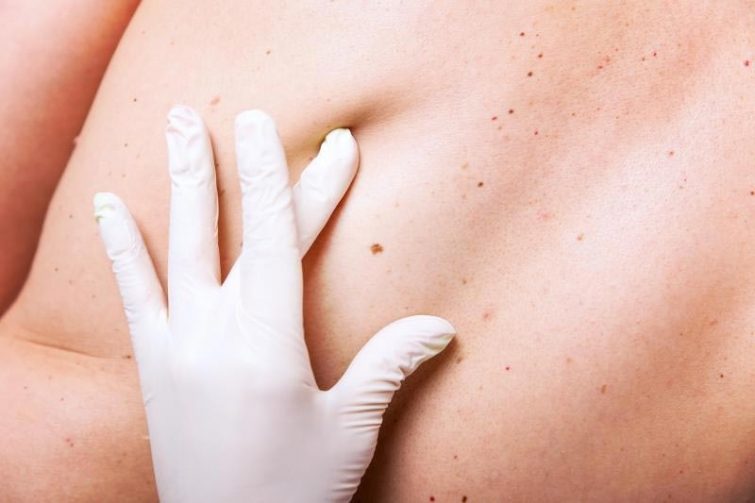 11 фактов о раке коже