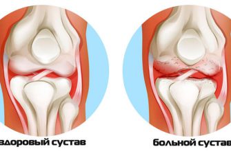Что делать при артритах, артрозах? Бесценные рекомендации восточной медицины!