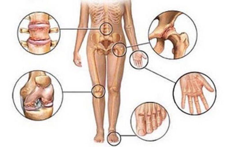 Боль в костях и суставах: 5 домашних, натуральных ПРОТИВОВОСПАЛИТЕЛЬНЫХ средств