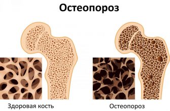 Берегите себя и близких! Советы и предложения по предотвращению остеопороза