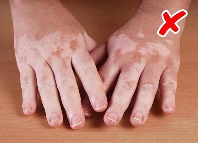 Заболевания, о которых сигнализирует наша кожа