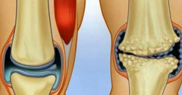 Врач натуропат рекомендует: простое средство для восстановления хрящей коленей, суставов и укрепления костей!