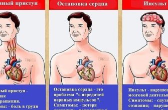 Это может спасти вам жизнь: разница между инфарктом, инсультом и остановкой сердца