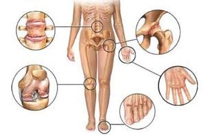 Причины и методы лечения артрита