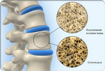 Диагностика и профилактика остеопороза