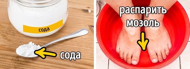 Как легко избавиться от мозоли