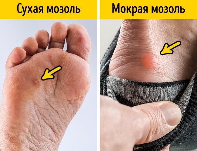 Как легко избавиться от мозоли