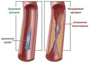 Что такое холестерин, и откуда берутся холестериновые бляшки?