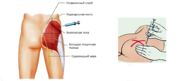 Как сделать укол самому себе