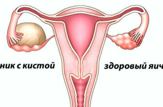 Киста яичника: что нужно знать женщинам после 40