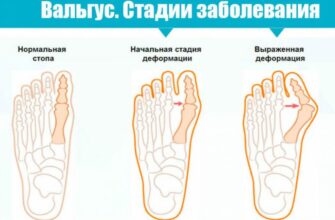 Почему происходит вальгусная деформация стопы