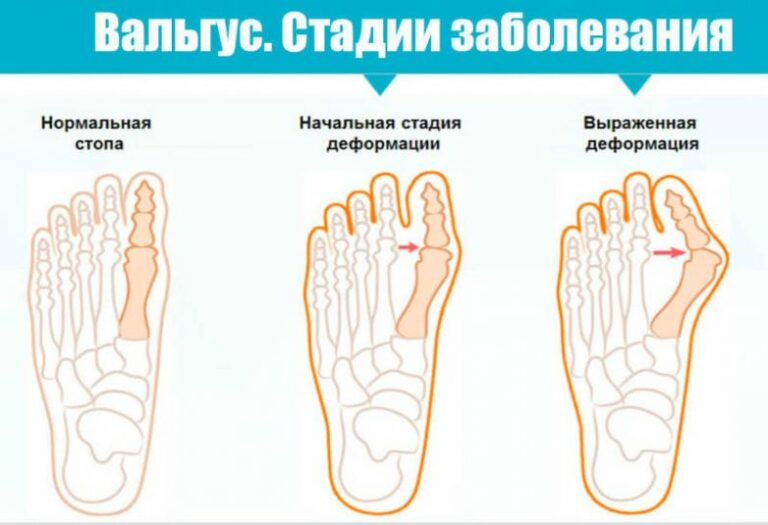 Вальгусная деформация большого пальца стопы фото