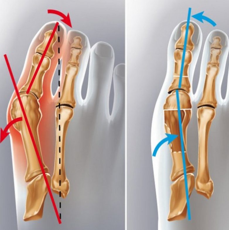 Упражнения при вальгусной деформации стопы