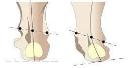 Упражнения при вальгусной деформации стопы