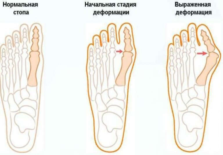 Вальгусная деформация стопы стадии фото
