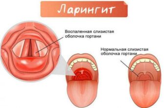 Ларингит и его основные симптомы о которых стоит знать