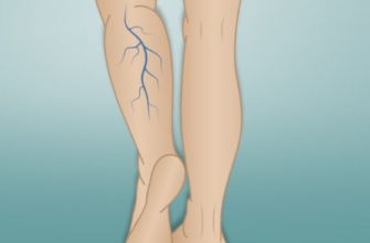 Эффективные методы лечения варикоза с точки зрения Аюрведы