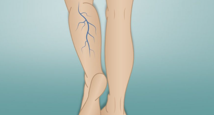 Эффективные методы лечения варикоза с точки зрения Аюрведы